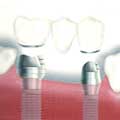 Dent ou bridge sur implant