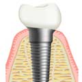 Etude appropriée pour implants dentaires