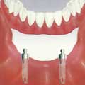 Stabilisation de votre dentition